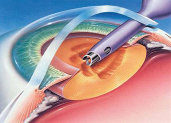 cataract-advancement