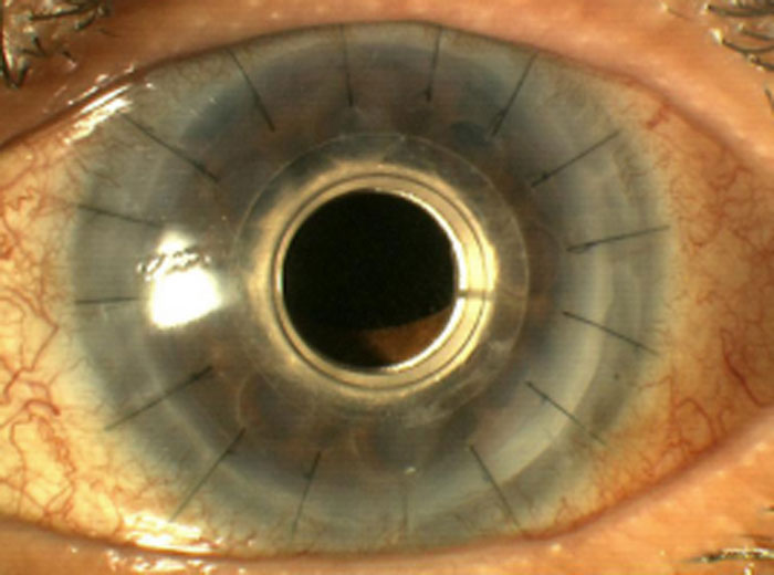 corneal-blindness