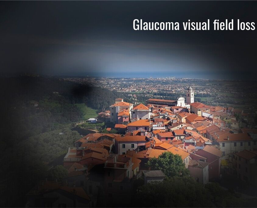 glaucoma-visual-field-loss